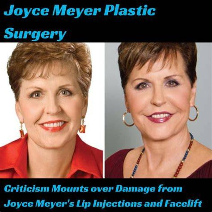 Joyce Meyer's Plastic Surgery Journey: Unveiling The Truth